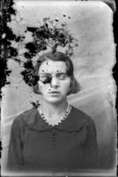 young woman blind in one eye